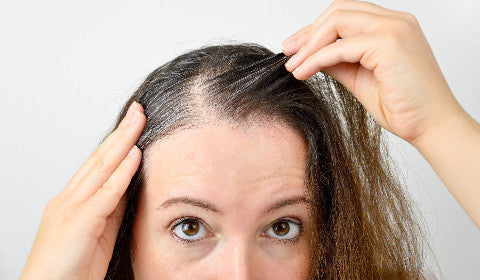 What is Traction Alopecia?